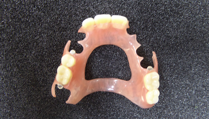 ノンクラスプ義歯の画像