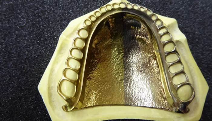 チタン床義歯の画像