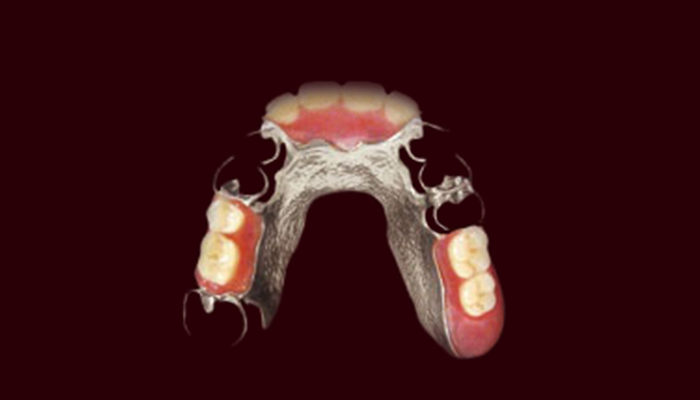 コバルトクロム床義歯の画像