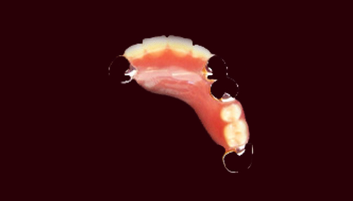 プラスチック義歯の画像